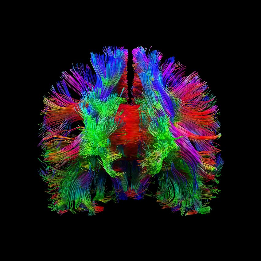 KI-basierte Alzheimer-Früherkennung Hirnvolumetrie Zürich