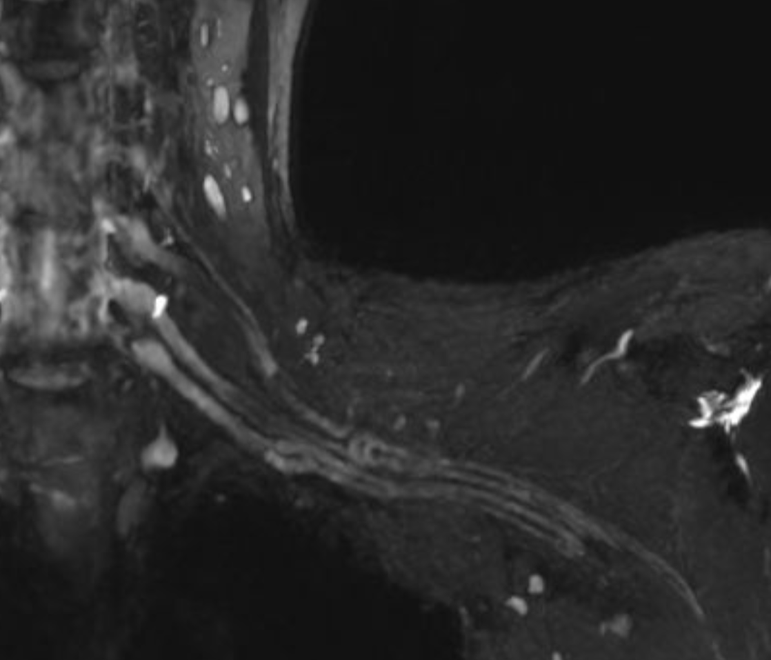 MR Plexus brachialis Zürich