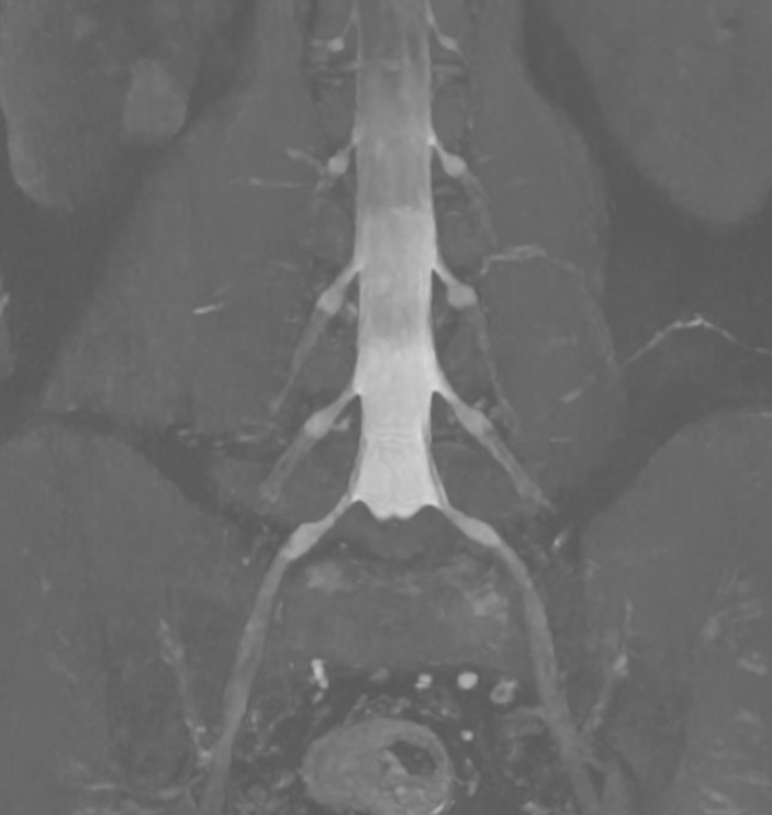 MR Plexus lumbosacralis Zürich