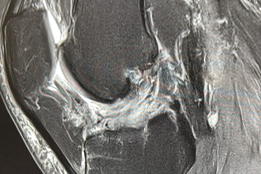 MRI