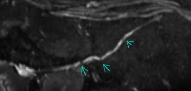 Parsonage-Turner-Syndrom: Neuropathie Nervus suprascapularis im MRI