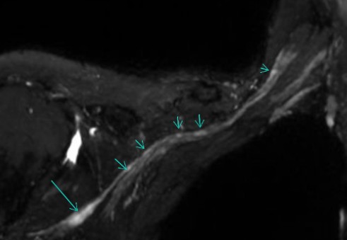 Parsonage-Turner-Syndrom MRI Zürich